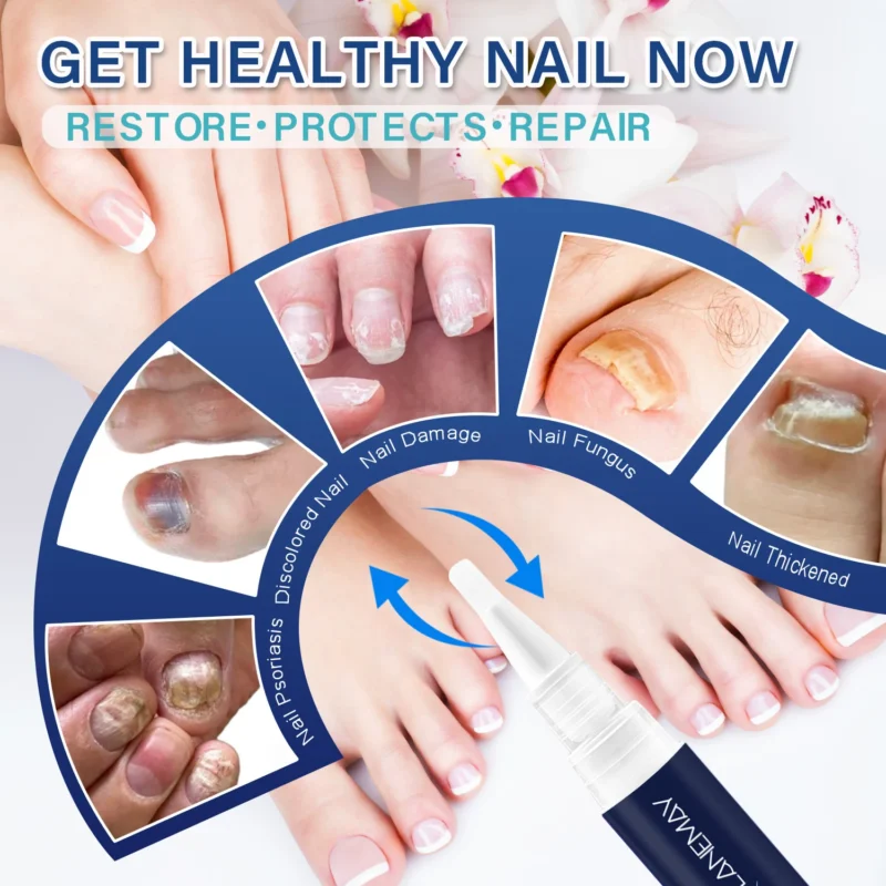 Lanemay Nail Repair Pen Antifungal Treatment Spu1016486362844 4