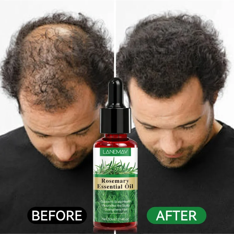 Rosemary Hair Essential Oil Scalp Treatment Spu1017931626931 2